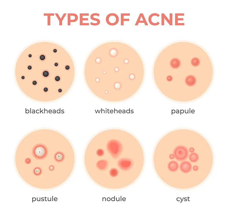 acne treatment moore norman